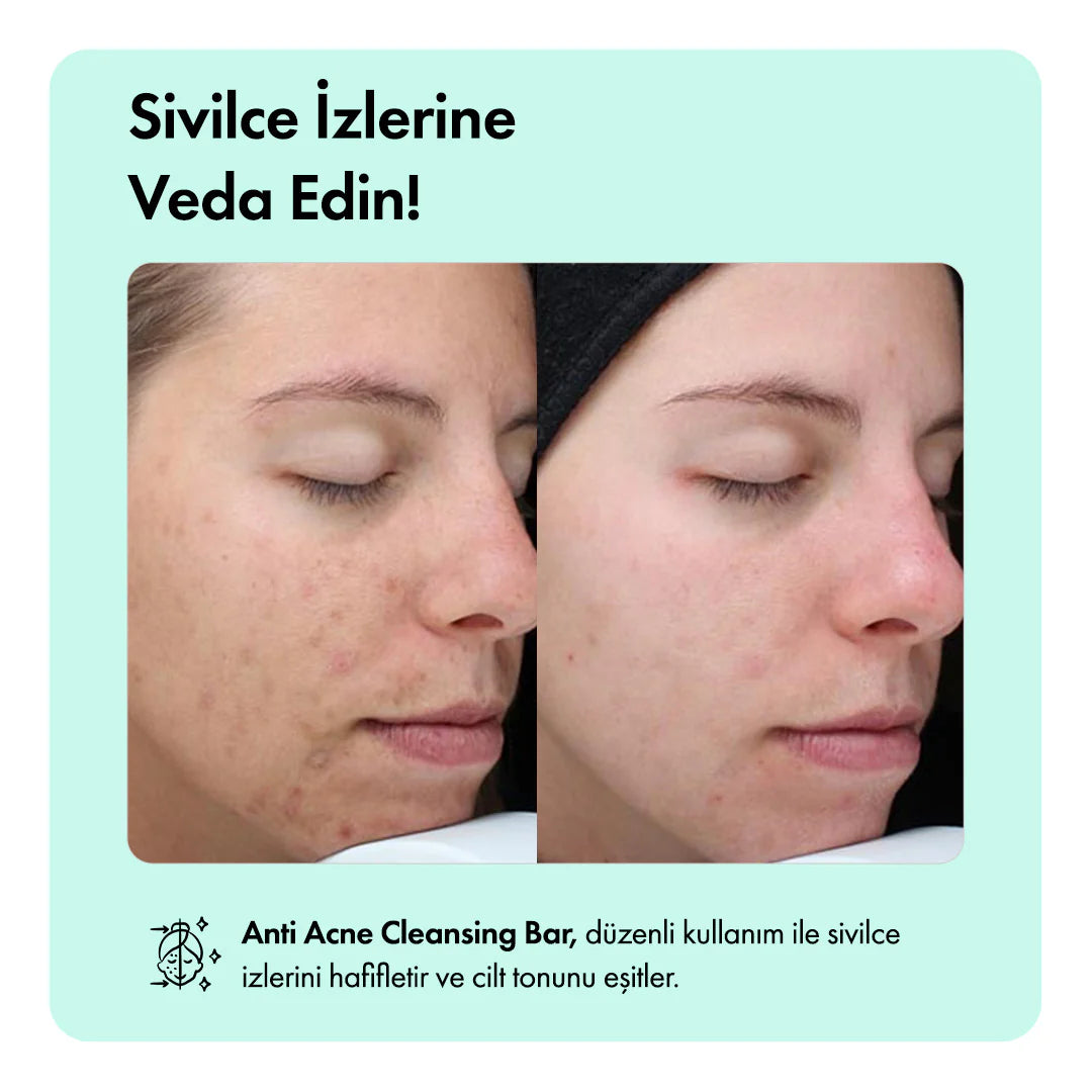 Kaplan Otu Özlü Canlandırıcı, Nemlendirici ve Acne Karşıtı Temizleme Barı 85g 3oz