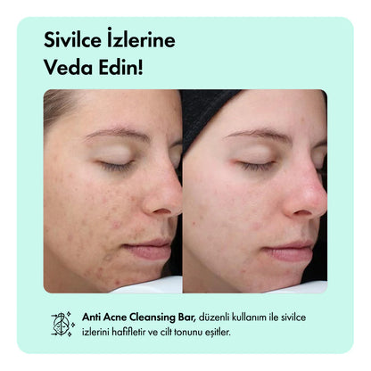 Kaplan Otu Özlü Canlandırıcı, Nemlendirici ve Acne Karşıtı Temizleme Barı 85g 3oz
