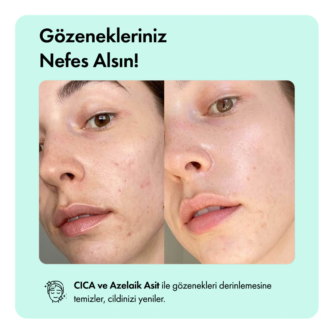 Kaplan Otu Özlü Canlandırıcı, Nemlendirici ve Acne Karşıtı Temizleme Barı 85g 3oz