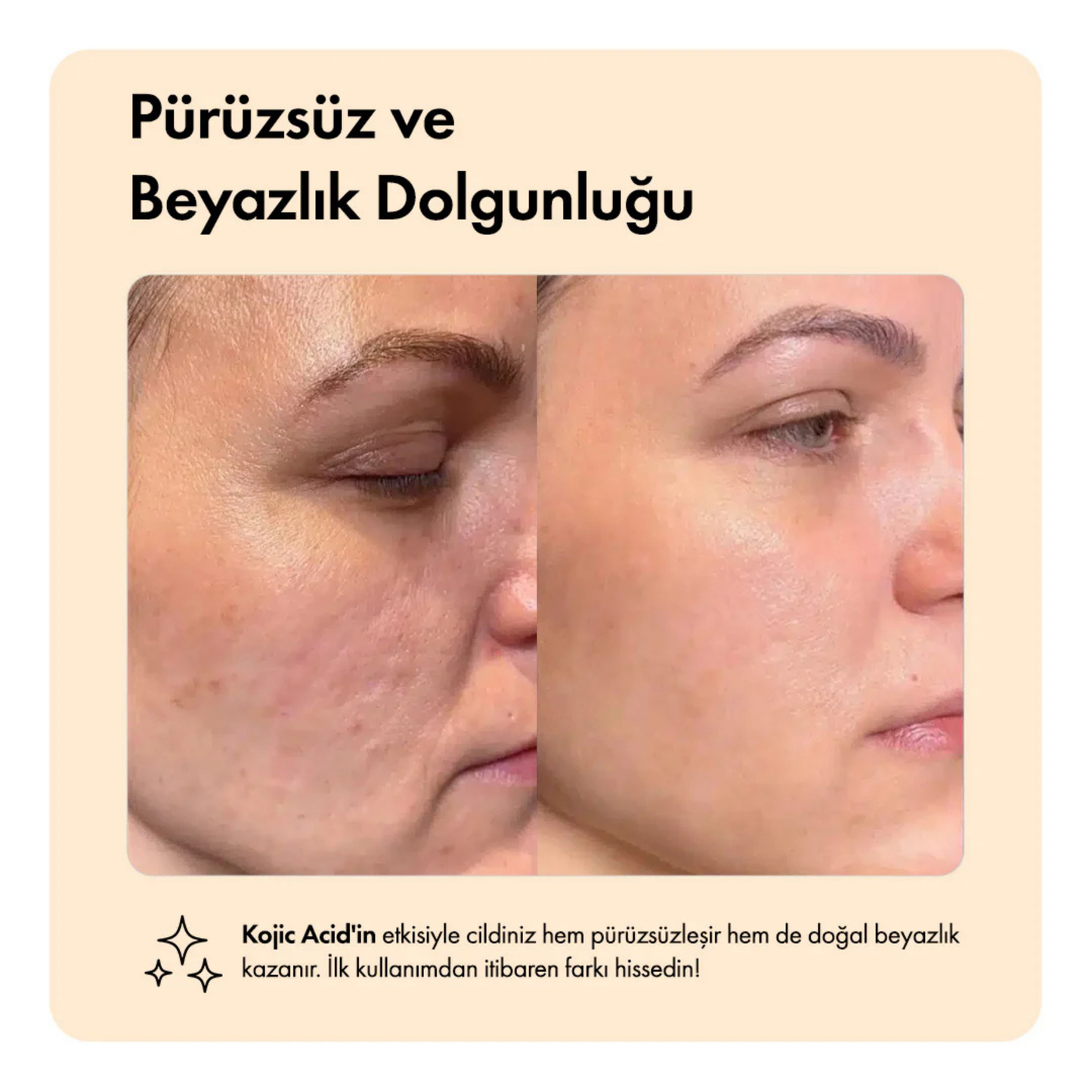 Kojik Asit & Zerdeçal Leke Karşıtı & Cilt Tonu Eşitleyen Aydınlatıcı Cildi Parlatan Yüz Serumu 30 ml