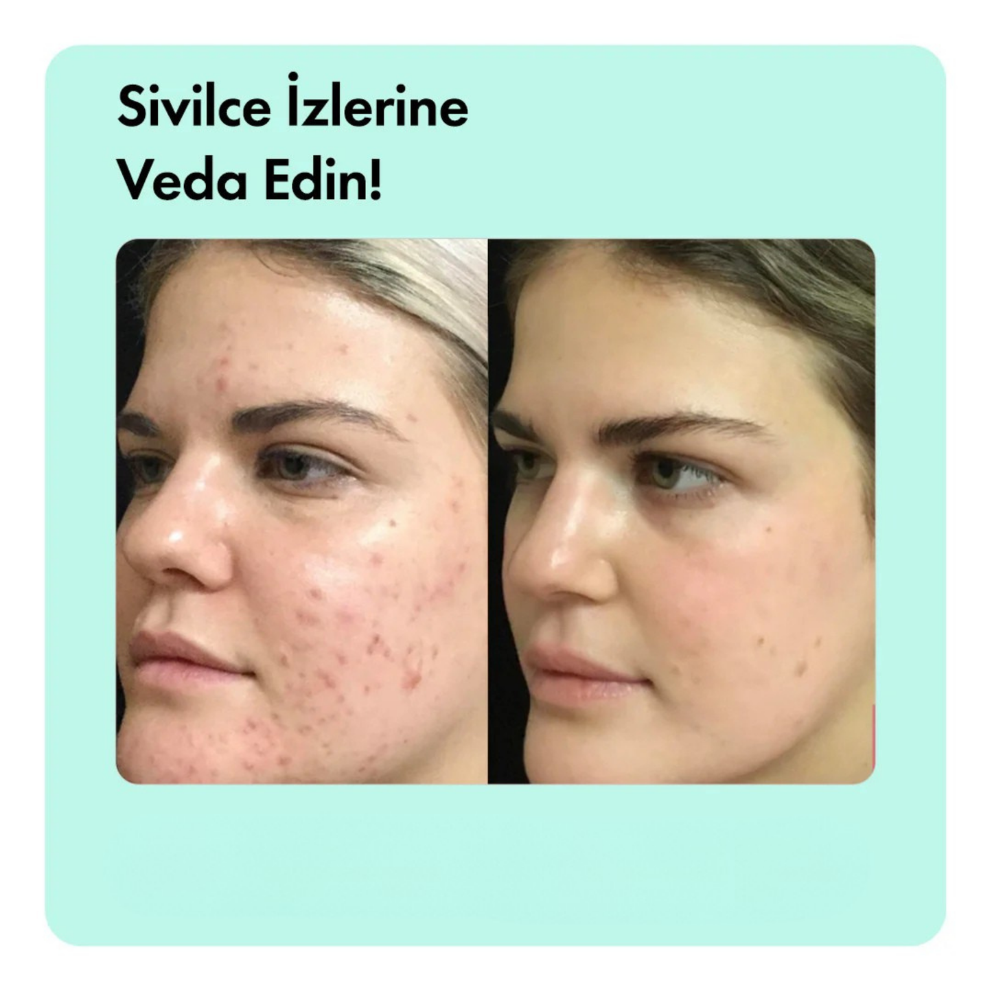 Kaplan Otu Özlü Canlandırıcı, Nemlendirici ve Acne Karşıtı Yüz Serumu 30 ml